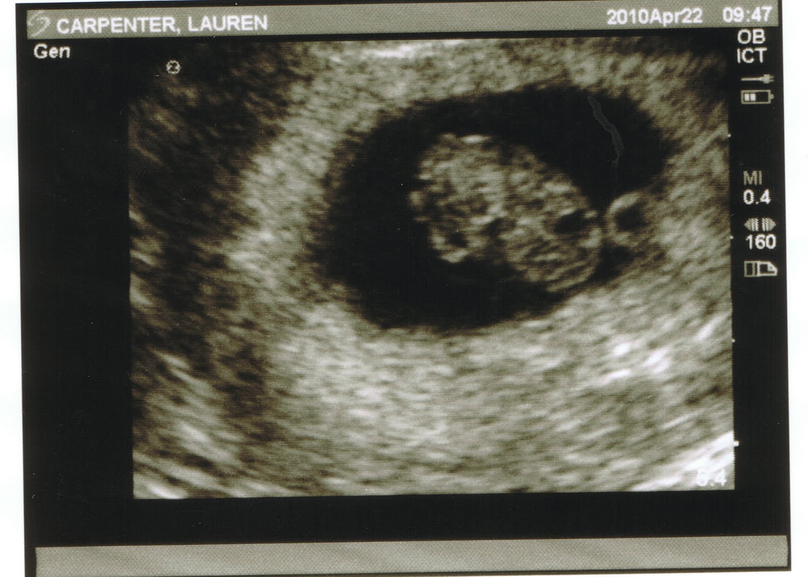 Baby Swanpenter: 8 Weeks, 3 Days Ultrasound