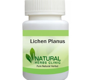 Herbal Product for Lichen Planus