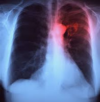 Embolie pulmonaire (EP ) est une pathologie extrêmement fréquente et hautement mortel qui est une des principales causes de décès dans tous les groupes d'âge .