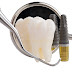 Implant nâng đỡ cầu răng