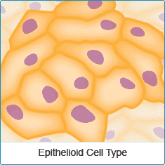 Epithelioid Mesothelioma