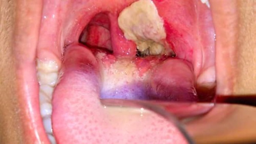 Beza Penyakit Tonsil Dan Difteria