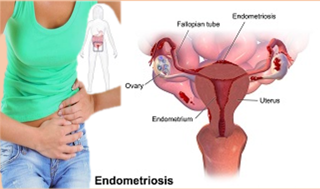 ketahui-tanda-lain-kista-endometriosis-selain-nyeri-haid