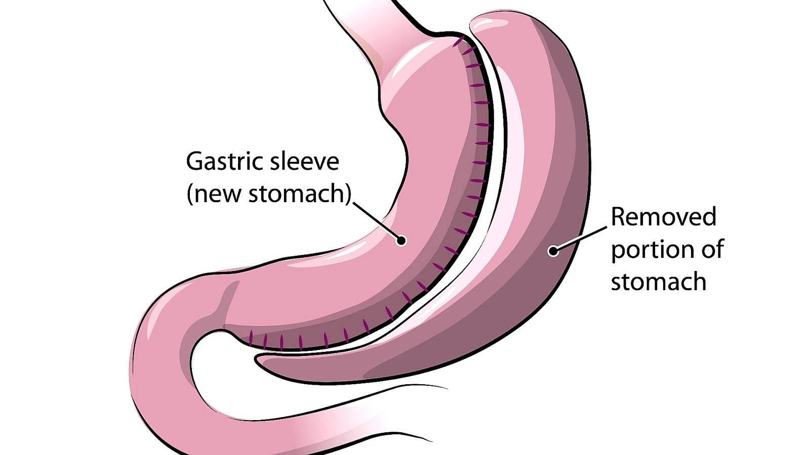 gastric sleeve