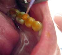 <Img src ="Aplicación-de-geles-de-fluoruros-gel-en-la-boca-de-los-niños.jpg" width = "200" height "178" border = "0" alt = "Aplicación de barniz de fluoruros en la clínica dental.">