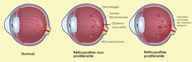 Rétinopathie Diabétique