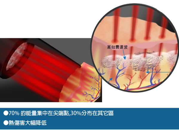 皮秒雷射心得分享│再也不用忍受冗長治療計畫了