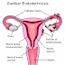 Definition and Causes of Cysts Endometriosis