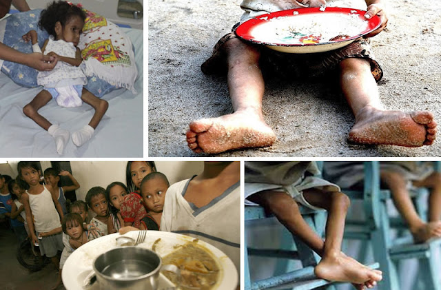 Cáritas encontró 379 niños más con desnutrición y bajos de peso