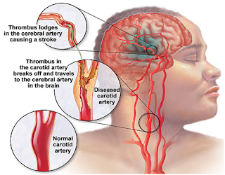 Heart diseases, symptoms and treatments