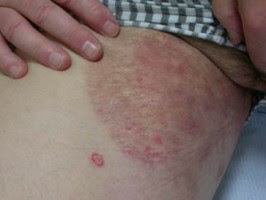 Obat Tinea Cruris Atau Infeksi Jamur Di Lipatan Paha