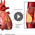 Heart Attack Cause and Immediate Treatment - Everyone Should Have to Know