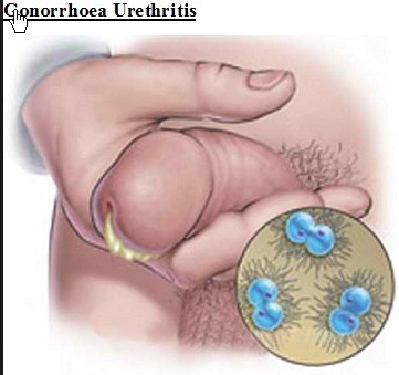 pengobatan kencing nanah dengan antibiotik