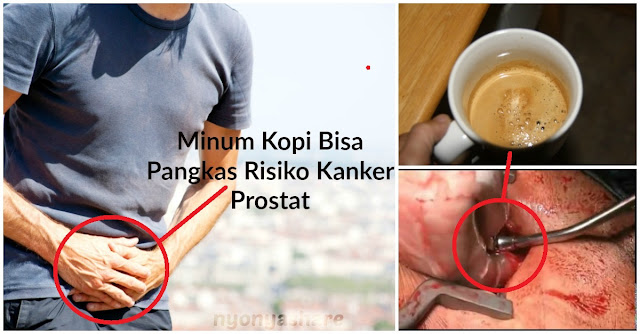 Bunda Sayang Suami ?? Beri Tahu Info Ini !! Minum Kopi Bisa Pangkas Risiko Kanker Prostat Hingga 50 Persen..