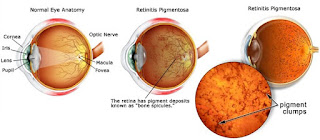 Retinosis Pigmentaria