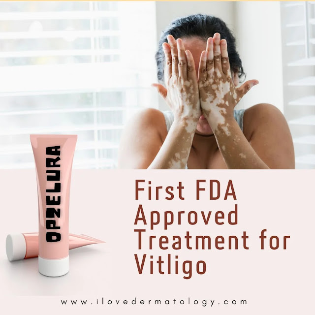 crema para vitiligo, crema para el vitiligo, univision, vitiligo tratamiento, fda approved vitiligo treatment,