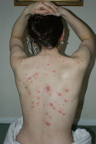 chickenpox