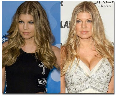 Did Fergie get breast implants