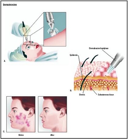 dermabrasion