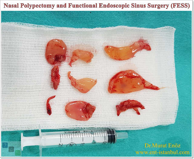 Nasal Polypectomy, FESS, Functional Endoscopic Sinus Surgery, Nose Polyp