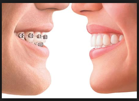 Mesa AZ Orthodontist White Spot Prevention with Dental Braces