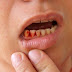 Nguyên nhân gây bệnh quanh răng