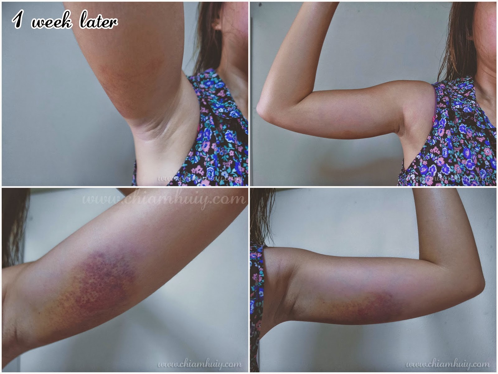 Fat freeze to reduce flabby arms | LUSH Aesthetics ...