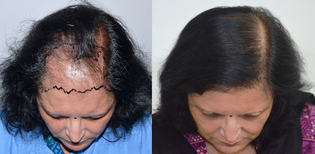  hair transplant in lucknow