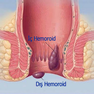 Hemoroid