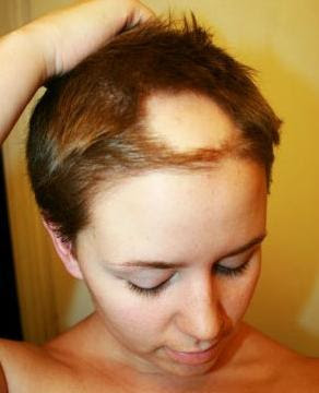 1. Hair Loss Alopecia