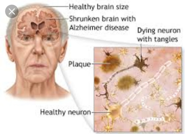 Alzheimer's Disease Symptoms Remedy