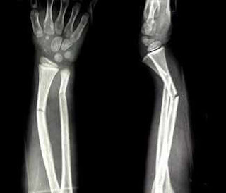 kol bilek kırık röntgen