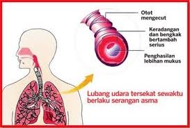 Poliklinik Bio-Sucinas: PENYAKIT ASTHMA (SEMPUT),RAWATAN 