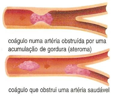 Enfarte do miocárdio | StreS'sNet