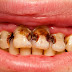  Nguyên nhân sâu răng ở trẻ em là gì