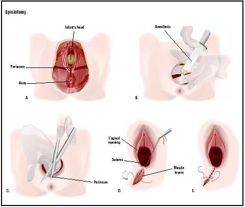 Ana Lyana's blog ©: TIPS MELEGAKAN JAHITAN EPISIOTOMI