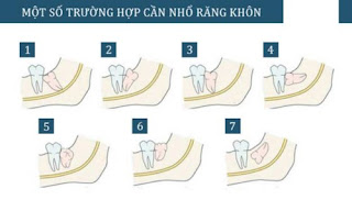 Răng khôn mọc thẳng có nên nhổ không-2