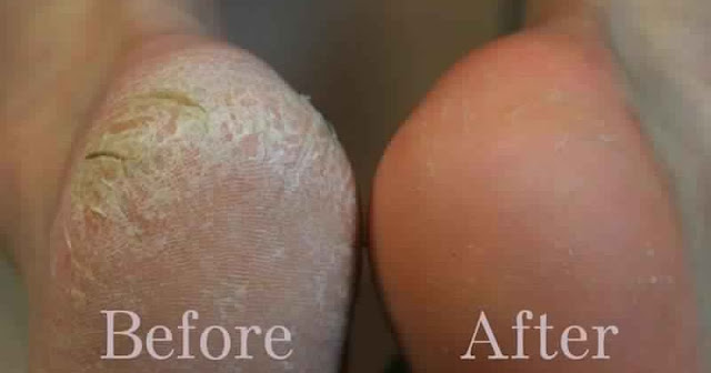 طريقة علاج خشونة جلد الكوعين والقدمين