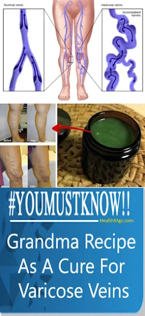 Grandmother RECIPE AS A CURE FOR VARICOSE VEINS