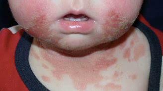 Treatment of contact dermatitis