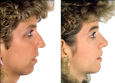Chin Augmentation Before And After