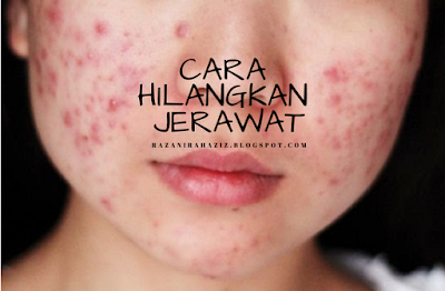 bahan semulajadi, bebas jerawat, cara hilangkan jerawat