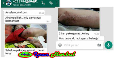 Obat Infeksi Luka Bernanah Paling Ampuh