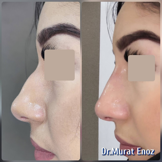 The 5 Minute Nose Job in Istanbul,Nose filler injection Turkey,