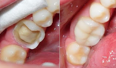 Những trường hợp nào nên tiến hành trám răng?