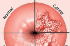 Perbezaan sel serviks normal atau abnormal