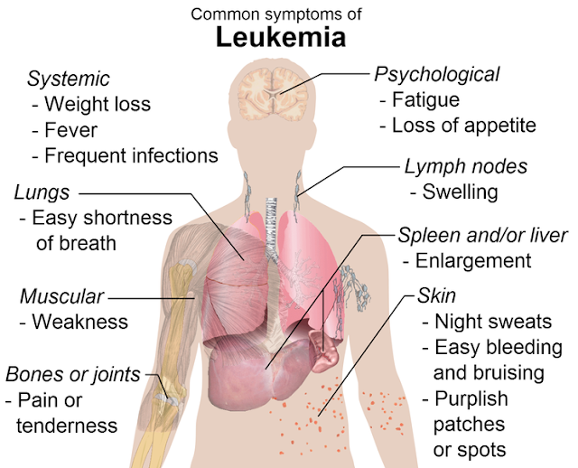 Leukemia Symtomps