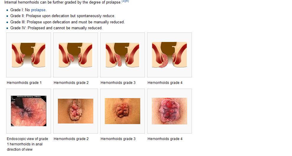 Hannan Medispa : Buasir / hemorrhoid