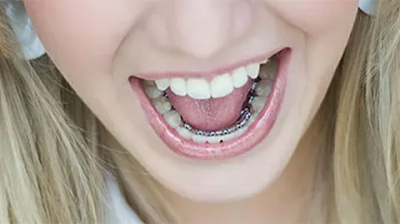 Lingual Braces Service in Melbourne