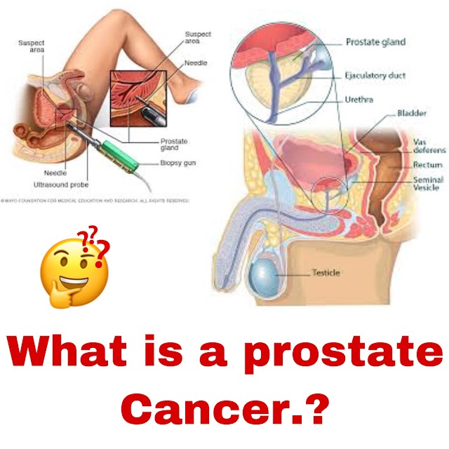 What is a Prostate cancer.? 